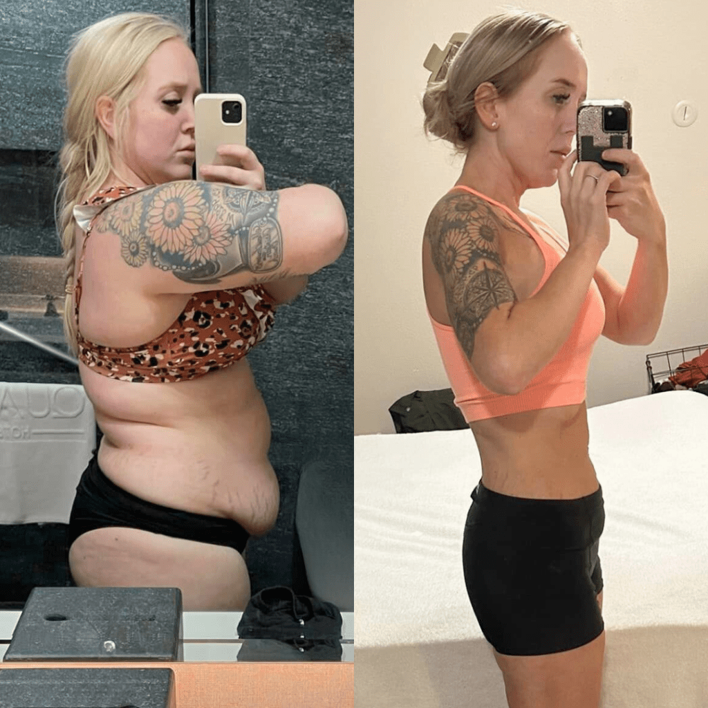 Gastric Sleeve Before and After Result - Dr. Gabriela Rodriguez Gastric Sleeve Before and After Result - Dr. Gabriela Rodriguez