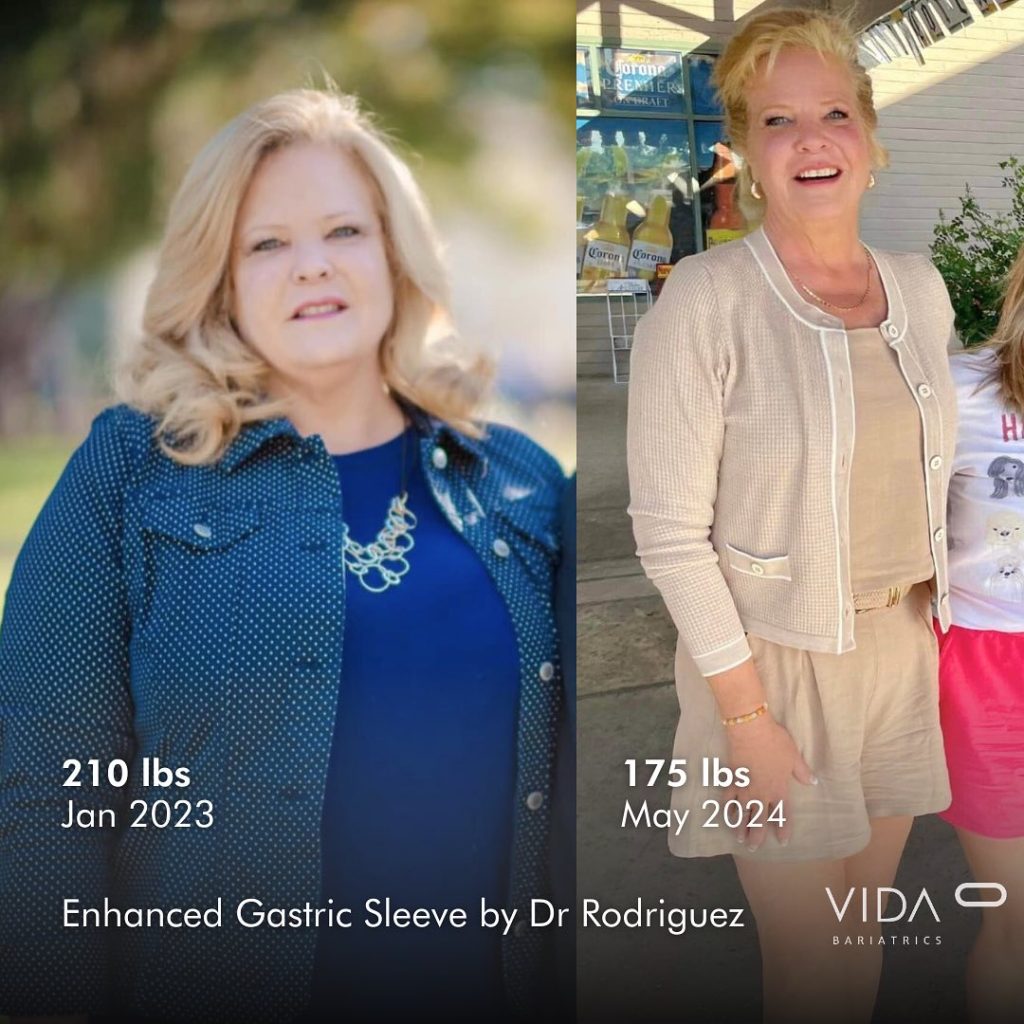 Gastric Sleeve Before and After Result - Dr. Gabriela Rodriguez Gastric Sleeve Before and After Result - Dr. Gabriela Rodriguez