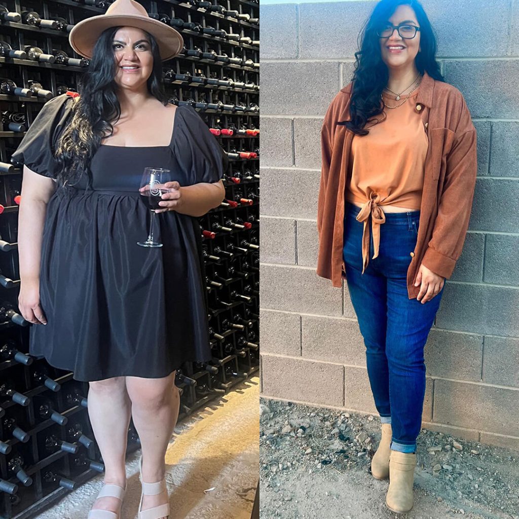 Gastric Sleeve Before and After Result - Dr. Gabriela Rodriguez Gastric Sleeve Before and After Result - Dr. Gabriela Rodriguez