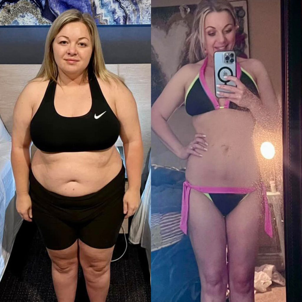 Gastric Sleeve Before and After Result - Dr. Gabriela Rodriguez Gastric Sleeve Before and After Result - Dr. Gabriela Rodriguez