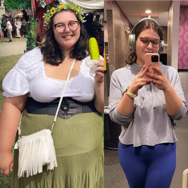 Gastric Sleeve Before and After Result - Dr. Gabriela Rodriguez