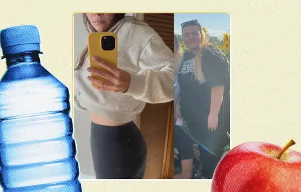 single incision gastric sleeve Tijuana