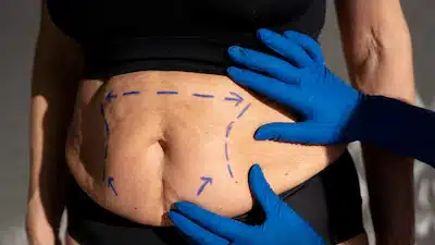 Lap band to gastric sleeve revision Tijuana